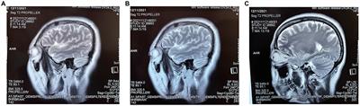 Fire acupuncture for anti-LGI1 antibody autoimmune encephalitis: a case report